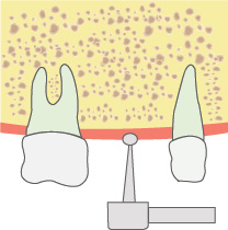 インプラント埋入位置に目印を付ける