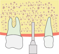 OAMキットで穴を拡大する