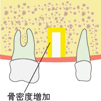 インプラントの太さまで開ける