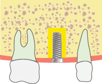 インプラントを埋め込む